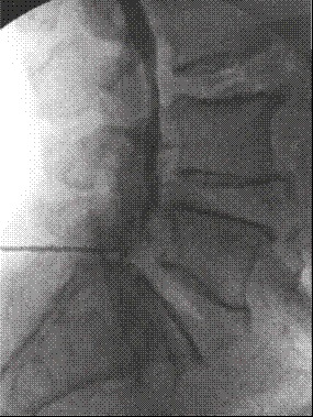 Proyecci&oacute;n lateral. Distribuci&oacute;n del medio de contraste