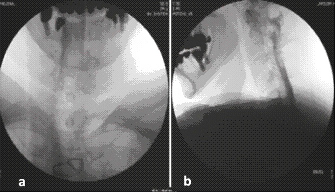 . Se observa patron de migracion del medio de contraste al espacio subdural