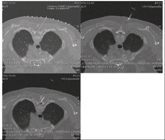 Mielograf&iacute;a din&aacute;mica guiada por TAC.Multiples fistulas de l&iacute;quido cefalorraqu&iacute;deo