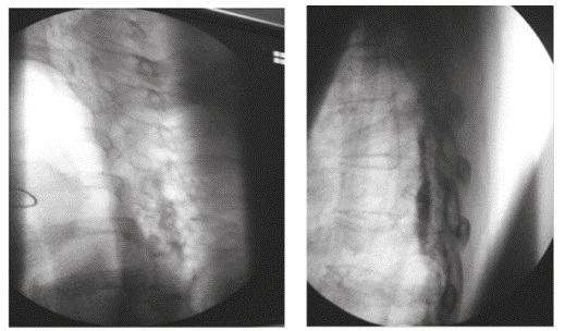 Vista lateral. Migracion del medio de contraste hasta C5 en el espacio epidural