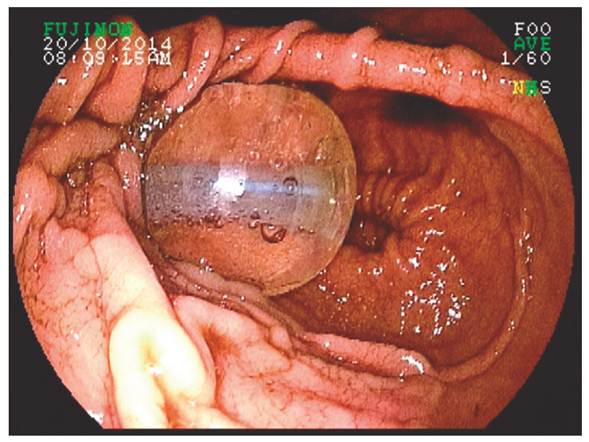 Balón de gastrostomía mal posicionado e inflado en el duodeno