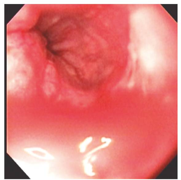 Se observa mejoría del aspecto de la mucosa esofágica y laceración con sangrado activo que fue sometida a escleroterapia
