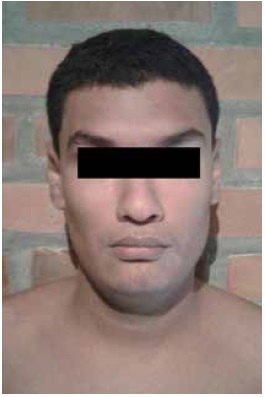 Proband, III-4. A 19-years-old male with full mutation. Facial features include long face, prognathism and large ears