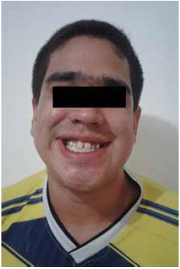 Case 2, III-1. A 19-years-old male with full mutation. Special findings include long face, broad forehead, synophrys, and prognathism