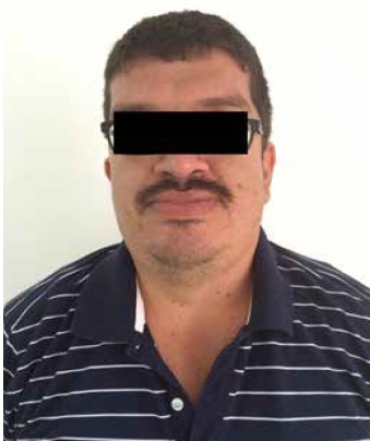 Case 3, II-1. A 37-years-old male with full mutation. Physical features include long face, large ears and prognathism