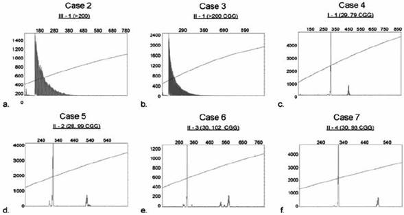 PCR analysis was performed for each case and CGG allele size was determined by capillary electrophoresis (CE) as shown in a-f. The X-axis indicates the size of the alleles in base pairs while the Y-axis indicates the fluorescence intensity of each allele. Plots a and b (Case 2 and Case 3) demonstrate the presence of a full mutation as reflected by the presence of uninterrupted serial peaks13. Plots c-f (Case 4-7) show in all cases the presence of a premutation pattern, with the normal and premutation allele, which sizes are depicted in parenthesis