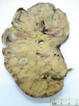 Ri&ntilde;&oacute;n derecho con severa alteraci&oacute;n de su apariencia, con p&eacute;rdida de la diferenciaci&oacute;n cortico-medular, &aacute;reas de aspecto necr&oacute;tico y material purulento