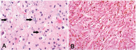 A C&eacute;lulas grandes con citoplasma granular eosinof&iacute;lico y n&uacute;cleo peque&ntilde;o (c&eacute;lulas de von Hansemann), muchas de ellas con inclusiones redondas basof&iacute;licas, algunas con aspecto s&oacute;lido y otras con aspecto en diana, tama&ntilde;o variable (cuerpos de Michaelis-Gutmann). Las flechas se&ntilde;alan 3 de ellas, pero hay m&uacute;ltiples en esta imagen. (Hematoxilina-eosina, aumento original: X400). B. Tejido renal con tinci&oacute;n de Von Kossa para calcio, en el que se resaltan m&aacute;s los cuerpos de Michaelis-Gutmann, evidenciando gran cantidad de ellos. (Aumento original, X400)