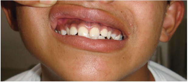 Se observa la hiperpigmentación en encías y acné en área peribucal