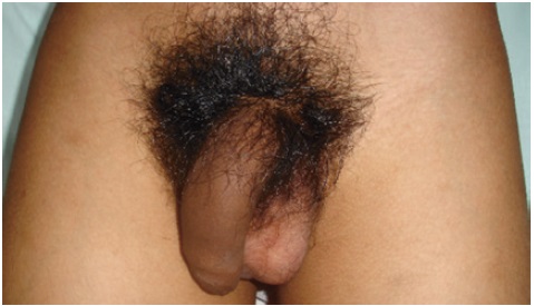 Genitales masculinos externos. Se observa vello púbico Tanner 4, pene de 11 cm x 1,5 cm y volumen testicular de 3 mL