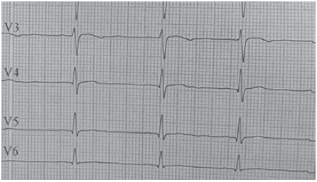 Derivaciones precordiales del electrocardiograma. Onda P aplanada con acortamiento PR. En V3 inversión de la onda T y en V4-V6 aplanamiento de la onda T, hallazgos compatibles con hipopotasemia