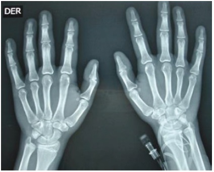 Se observa una edad ósea avanzada por el método de Greulich y Pyle correspondiente a 17 años