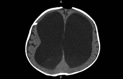 TAC cerebral simple. Ventriculomegalia que sugiere hidrocefalia.
