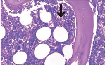 Hallazgos histológicos en la médula ósea. Biopsia de médula ósea (Giemsa, 40X), se observa la médula ósea hipocelular con la presencia de hemofagocito (flecha negra). Fuente: consentimiento, Nieto-Ríos et al. 8.