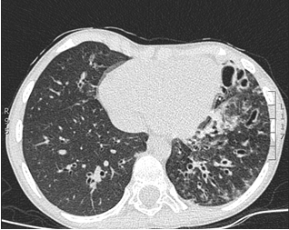 Tomografía de alta resolución de tórax. Se observa la presencia de cambios fibróticos subpleurales apicales bilaterales de predominio derecho, patrón en vidrio esmerilado hacia regiones parahiliares bilaterales de predominio izquierdo, múltiples bronquiectasias, atrapamiento del aire y pérdida de volumen del pulmón izquierdo. Fuente: propia, con autorización de los padres del paciente para su publicación.