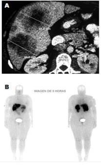 Imágenes de localización de insulinoma maligno en un paciente. Tomografía axial computarizada del abdomen. (A) gammagrafía con octreotide. (B). Mujer de 53 años con insulinoma maligno y multifocal de uno de los centros de referencia del estudio. Se resaltan las grandes y múltiples metástasis hepáticas. 