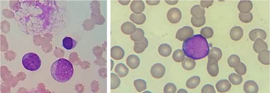 Alteraciones cuantitativas y cualitativas en los leucocitos. Campo microscópico 100x donde se evidencia leucocitosis, presencia de blastos y sombras de Gumprecht