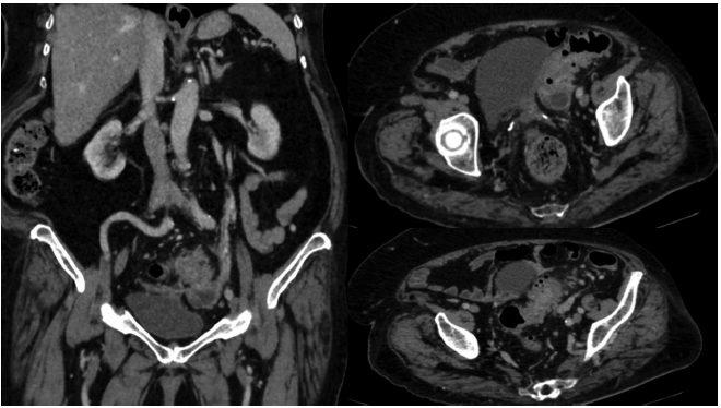 Tomografía contrastada de abdomen sin uso de contraste oral. Muestra una enfermedad diverticular del sigmoides con signos de diverticulitis y colección pélvica adyacente.