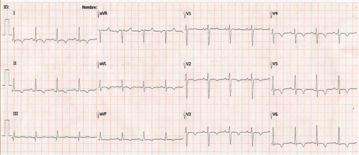 Hallazgos electrocardiográficos: inversión de ondas T simétricas, alternancia eléctrica en V1, V2 y V3. Fuente: creación propia