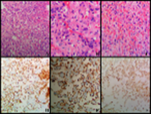 Hallazgos microscópicos e inmunohistoquímica. Neoplasia con patrón vasoformativo a bajo aumento (A), compuesta predominantemente por células con marcado pleomorfismo (B) y en menor proporción células fusiformes con atipia leve a moderada (C). (A: H&E x40; B: H&E x400; C: H&E x400). Las células neoplásicas son positivas por inmunohistoquímica para: D. CD31 (x200), E. CD34 (x200) y F. Factor VIII (x200).
