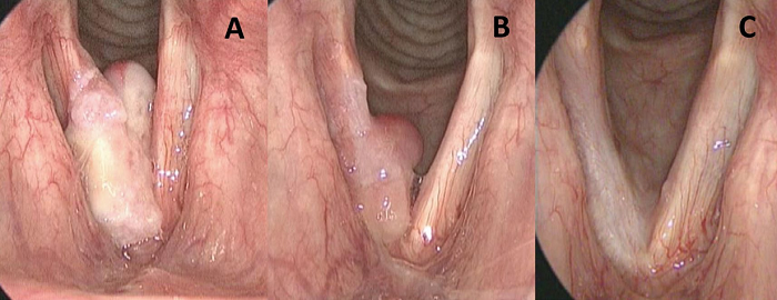 Estroboscopia lar�ngea prequir�rgica y de control posoperatorio