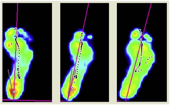 Different idiopathic toe walkers (ITW) models of step development: Type 1, 2 and 3 ITW