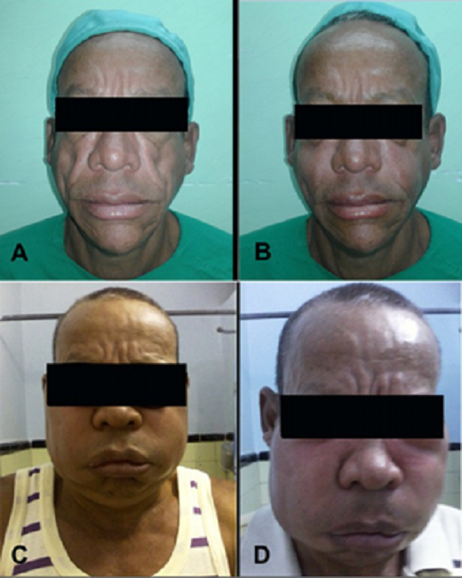 Lipoatrofia facial de paciente y resultados del tratamiento con PRPO3. Leyenda: (A) lipoatrofia facial en el paciente antes de la intervención;(B) después de la cuarta aplicación; (C) después de la quinta aplicación; (D) después de la sexta aplicación.