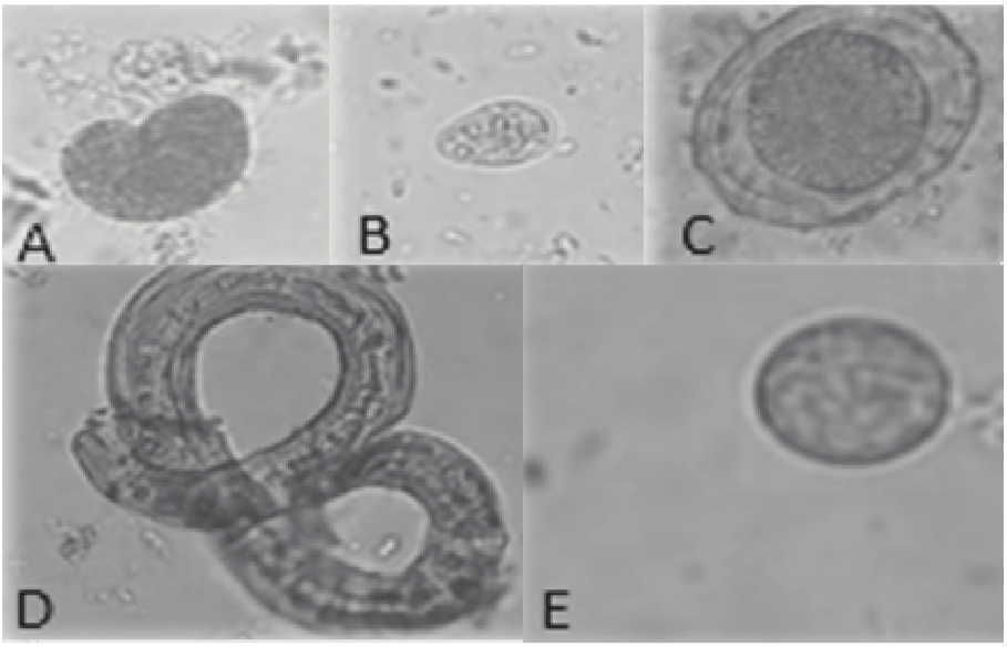 Parasitic
structures visualized in lettuce served in restaurants in the city of São Miguel do Oeste, Santa
Catarina State, Brazil. Parasitic structures visualized in
lettuce samples (400 x magnification). Source: photographed by the Vidigal and Landivar (2016). In A – Balantidium coli; B – Giardia spp.; C – Ascaris lumbricoides egg; D – S. stercoralis worm; E – Entamoeba spp.