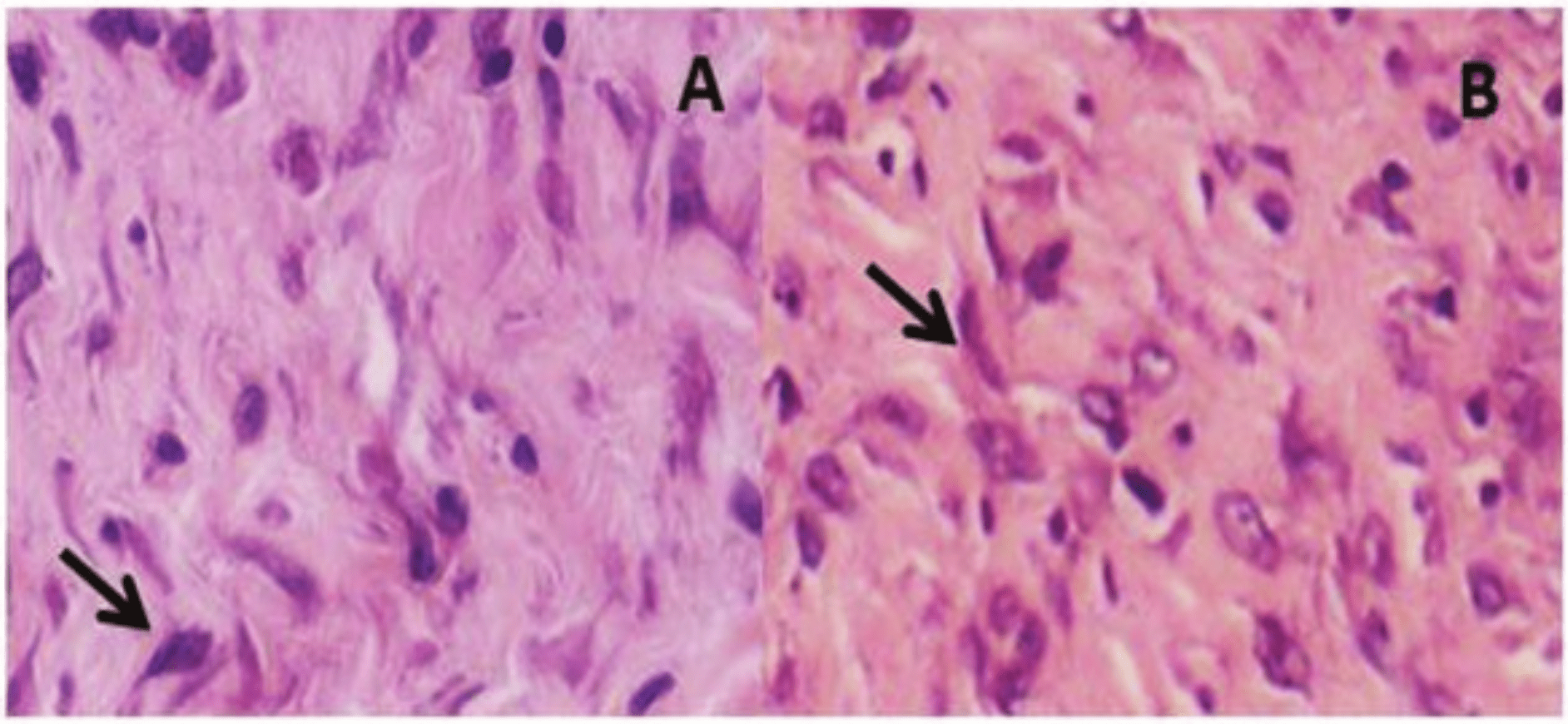 
Histological section rat skin stained with HE (fibroblast is indicated by the
arrow) obtained from control rats (A) and the group treated with pure protein
extract (B). Increase of 40 X