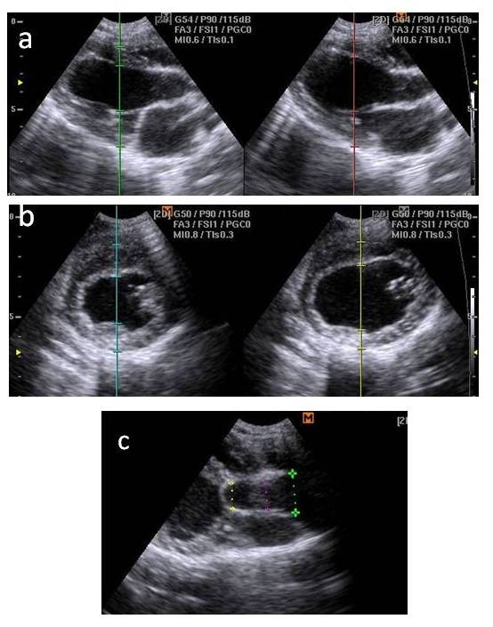 (a) Two-dimensional echocardiographic scan of a dog at the 6 months ultrasound scan demonstrating hypertrophied left ventricle with abnormal echocardiographic parameters and increased left ventricular mass and a decreased cardiac function. (b) Two-dimensional echocardiographic scan of a dog at the baseline ultrasound scan demonstrating normal echocardiographic parameters. (c) Two dimensional echocardiographic examination 3 months after banding of the ascending aorta. Notice the presence of the hyperechoic “commercial cable tie” at the mid-ascending aorta in non-constraining manner.