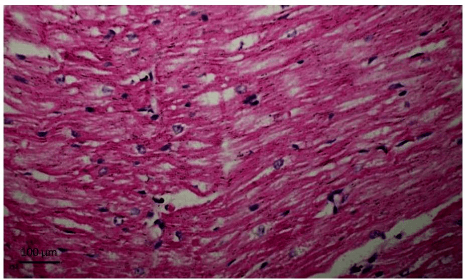 Histopathological section from the left ventricle at 6 months after banding of the ascending aorta demonstrating hypertrophied cardiomyocytes with interstitial fibrosis. Note the large hyperchromatic nuclei of the hypertrophied myocyte (H&E).