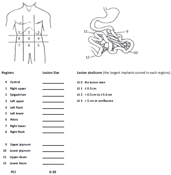 Staging system using the peritoneal cancer index (PCI) for peritoneal carcinomatosis. The abdomen and pelvis are divided into 12 regions. The size of the lesions of the largest implants are scored (from 0 to 3) in each abdominopelvic region, and a numerical score ranging from 1 to 39 is obtained.