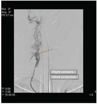 CT angiography of the right vertebral artery. The arrow points to the site of the vertebro-vertebral arteriovenous fistula with paracervical venous plexus overload. CT=computed axial tomography.