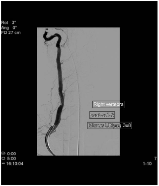 CT angiography following platinum coil embolization. The fistulous tract as well as the venous plexus overload have disappeared. CT=computed axial tomography.
