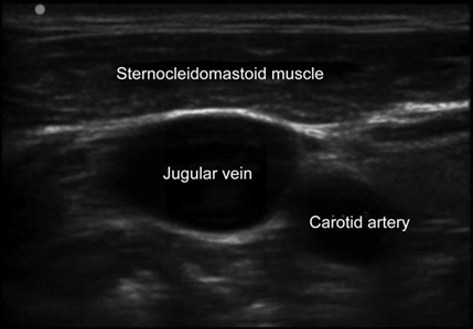 Ultrasound window showing the relationship between the jugular vein and its neighboring structures.