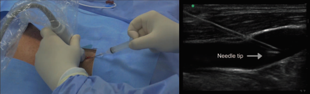 In-plane long-axis internal jugular access.