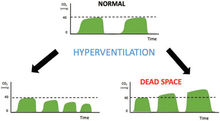 Capnography, dead space.