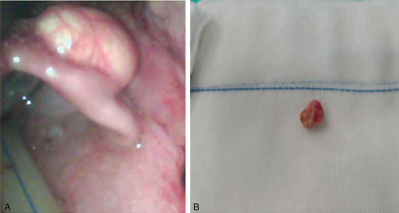 (A) Epiglottic mass seen through the video-lanryngoscope. (B) Epiglottic mass following the surgical resection.