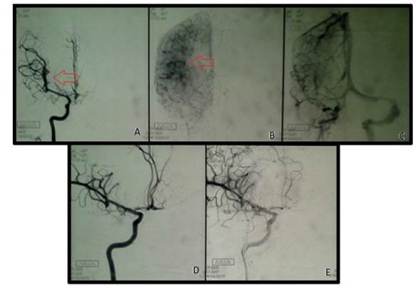 Panangiotomografía. a) fase arterial precoz: aneurisma en arteria temporal anterior derecha; b) fase de lavado arterial: evidencia de sangrado subaracnoideo (flecha); c) fase venosa; d y e) vista sagital