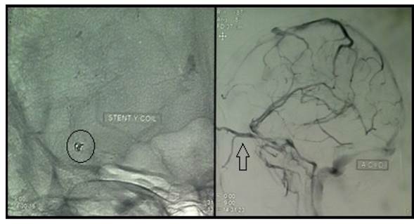 Resolución de aneurisma. Se observa la localización de stents y coils (izq.) y permeabilidad de la arteria temporal anterior derecha (der.)