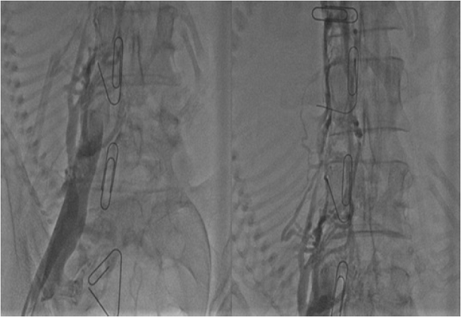 A. Flebograf&iacute;a de vena iliaca externa y vena cava inferior. B. Defecto de llenado por trombosis de vena cava inferior (im&aacute;genes autorizadas por servicio de hemodinamia, Fundaci&oacute;n Valle del Lili).