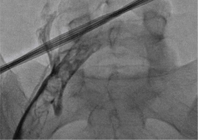 Imagen donde se observa trombo a nivel de transici&oacute;n de vena femoral e iliaca externa, con defecto de paso de medio de contraste durante venograf&iacute;a para trombolisis (im&aacute;genes autorizadas por servicio de hemodinamia, Fundaci&oacute;n Valle del Lili).