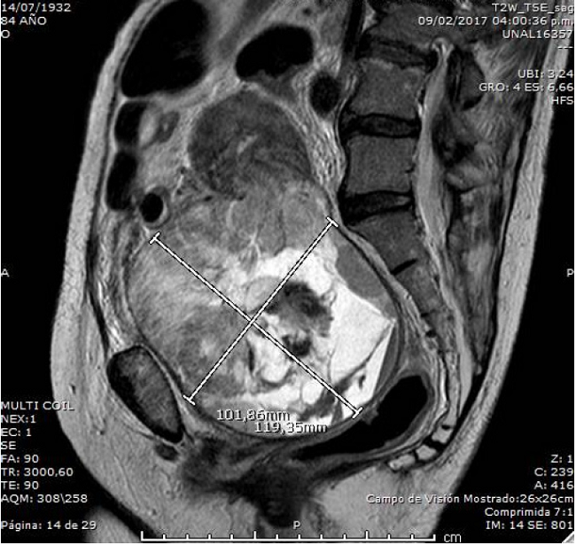 Abdominopelvic nuclear magnetic resonance in a patient with cervical carcinosarcoma; 11 cm, round-shaped mass with well-defined edges, arising from the uterine cervix