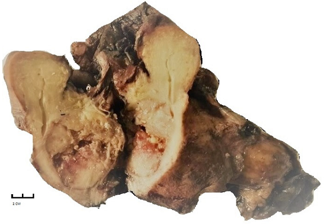 Gross appearance of cervical carcinosarcoma. Tumour localised to the posterolateral region of the cervix, with parametrial extension and large necrotic areas and areas of mixoid appearance