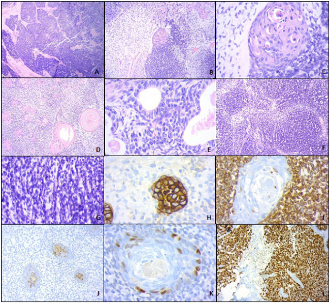 A: H&E 4X, small-cell component of the cervical carcinosarcoma; B: H&E 10X, mesenchymal component with mixoid matrix and epithelial component with transition from undifferentiated area to small squamous differentiation nodule, enhanced in C (H&E 40X); D (H&E,4X): squamous beads in a background of undifferentiated mesenchymal component; E (H&E40x): epithelial component with glandular differentiation; F and G (H&E, 4x and 10x, respectively): undifferentiated mesenchymal component with great mitotic activity; H (cytokeratin AE1-AE3, 40x): membrane marking in the epithelial component; I (vimentin, 40X), reactivity in the mensenchymal component; J and K (cytokeratin 5/6, 10x and p63, 40x): showing marking in the squamous cell component; L (ki 67, 10x): showing nearly 100% immunoreactivity in the undifferentiated epithelial component.
