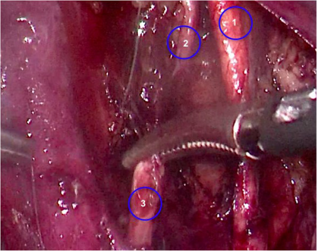 Nervio obturador con sección completa. 1) arteria vesical superior; 2) segmento distal del nervio obturador; 3) segmento proximal del nervio obturador