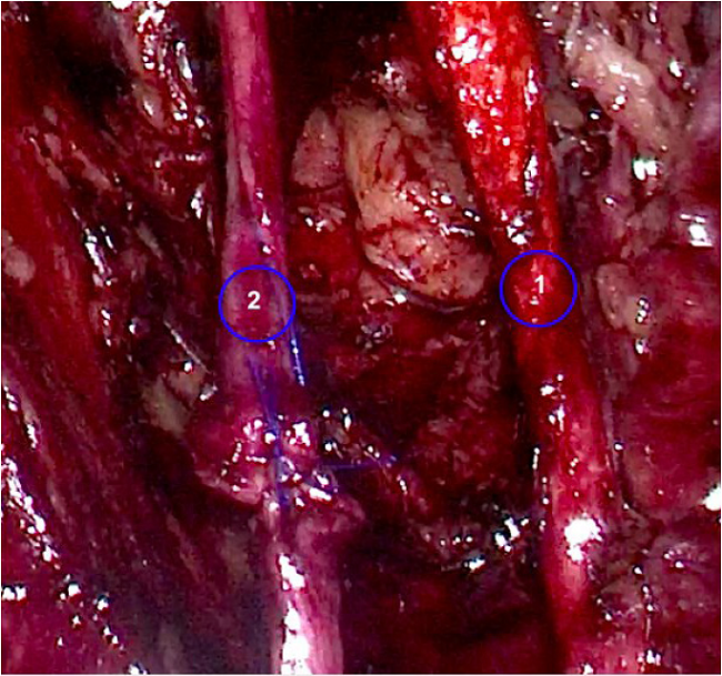 Neurorrafia primaria con anastomosis término-terminal con sutura no absorbible: 1) arteria vesical superior; 2) nervio obturador