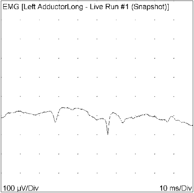 Registro electromiográfico de ondas agudas positivas (denervación) de músculo adductor largo izquierdo (Nervio Obturador) con presencia de fibrilaciones