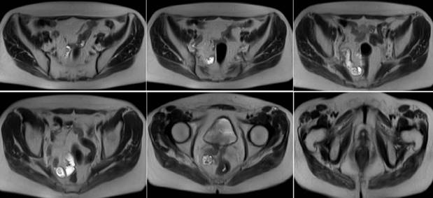 Imágenes del estudio radiológico en el que se observa la afectación neoplásica neovaginal