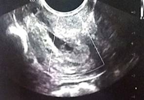 Ecografía pélvica transvaginal. A nivel endocervical (distal al orificio cervical interno) se observa saco gestacional único irregular con pérdida de la turgencia y elongación distal que mide 18 x 7 mm, en cuyo interior se identifica saco vitelino de 3 mm. La imagen es compatible con un embarazo ectópico cervical de 5 semanas, 6 días